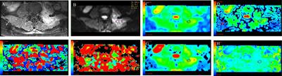 Intravoxel incoherent motion to differentiate spinal metastasis: A pilot study